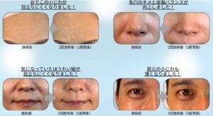 塗るボトックス