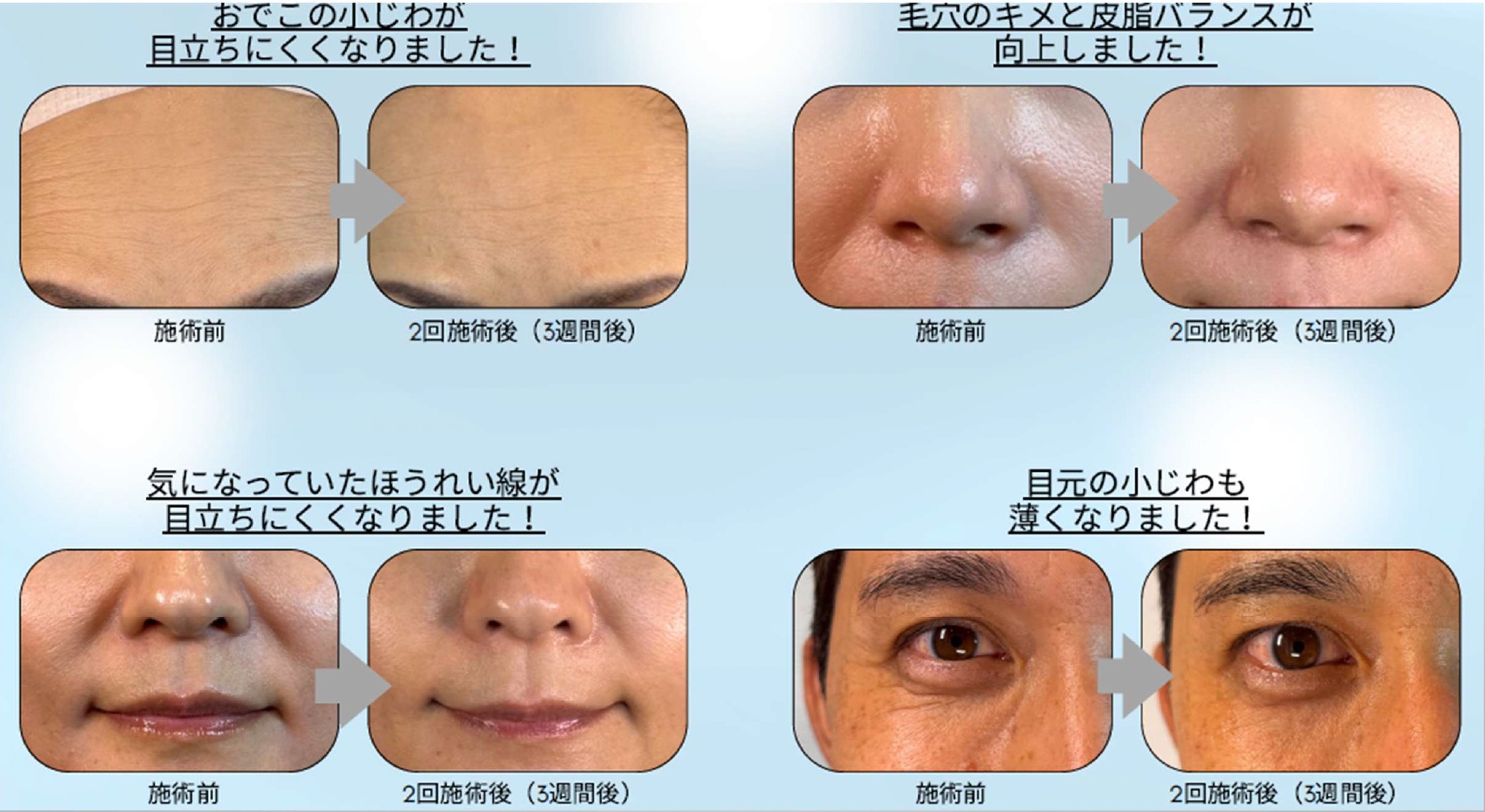 塗るボトックス