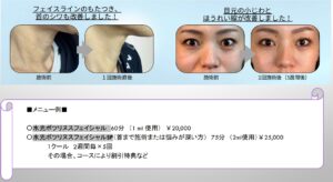 塗るボトックス