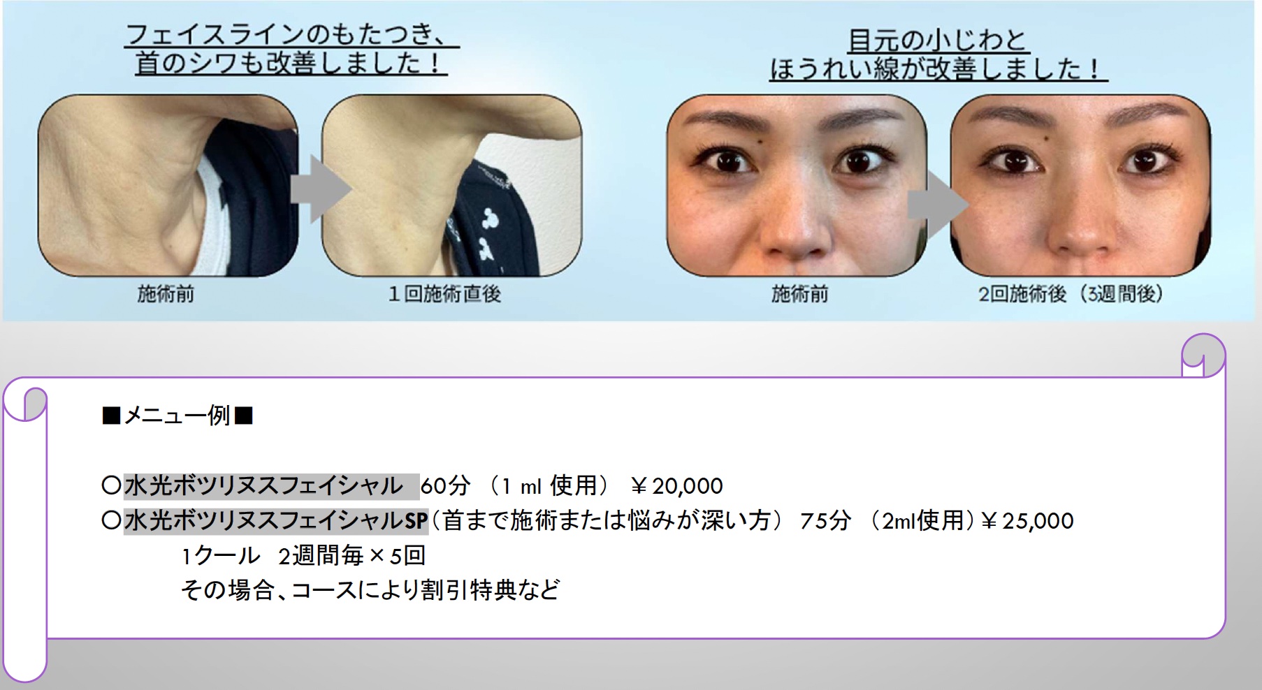 塗るボトックス